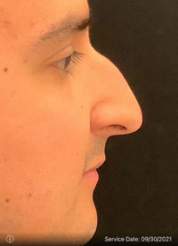 Rhinoplasty