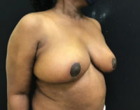 Breast Reduction