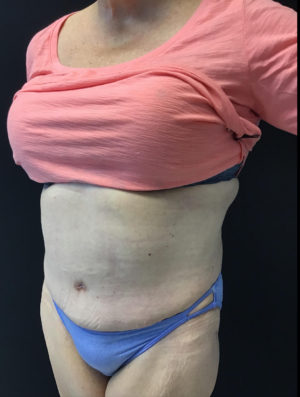 Tummy Tuck