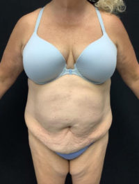 Tummy Tuck