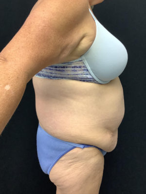 Tummy Tuck