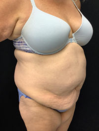 Tummy Tuck