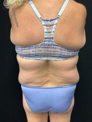 Tummy Tuck