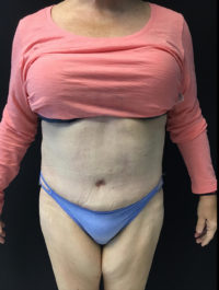 Tummy Tuck