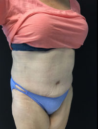 Tummy Tuck