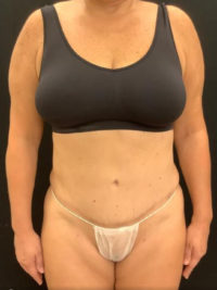 Liposuction