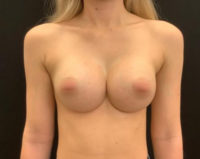 Breast Augmentation