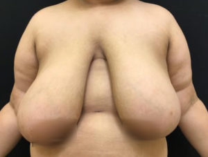 Breast Augmentation