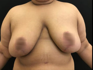 Breast Augmentation