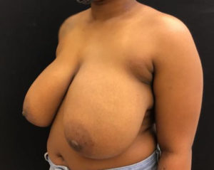 Breast Reduction