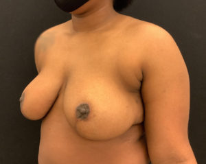 Breast Reduction