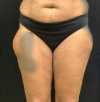 Liposuction