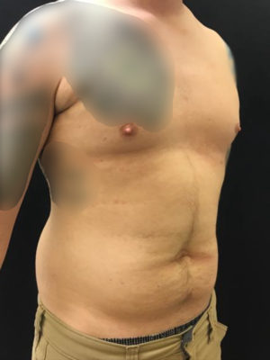 Liposuction