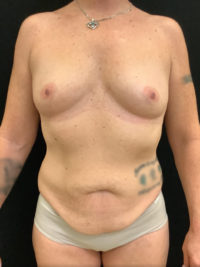 Tummy Tuck