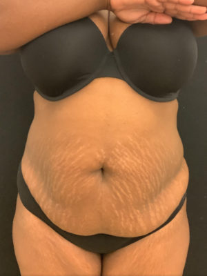Liposuction