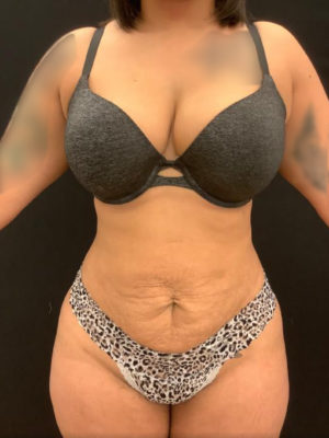 Liposuction