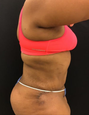 Tummy Tuck