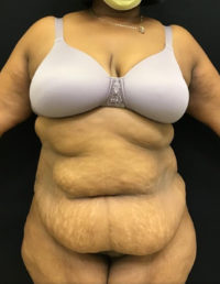 Tummy Tuck