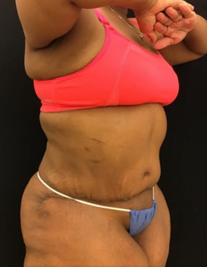 Tummy Tuck