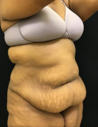 Tummy Tuck