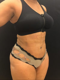 Tummy Tuck