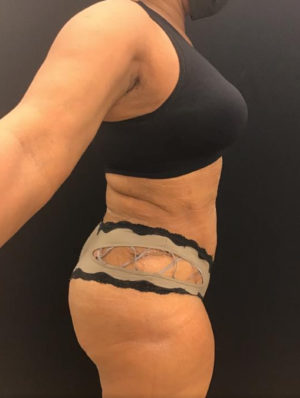 Tummy Tuck