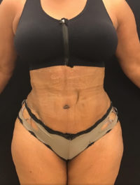 Tummy Tuck