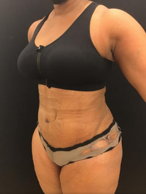 Tummy Tuck