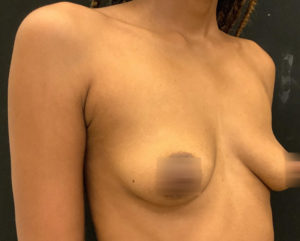 Breast Augmentation