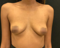 Breast Augmentation