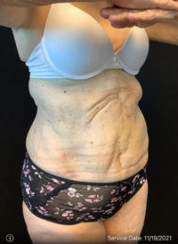 Liposuction