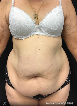 Liposuction