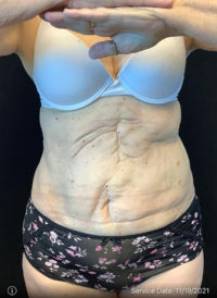 Liposuction