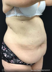 Liposuction