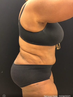 Tummy Tuck