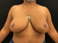 Breast Reduction