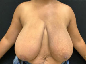 Breast Reduction