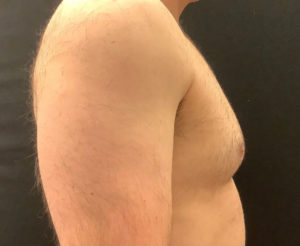 Gynecomastia