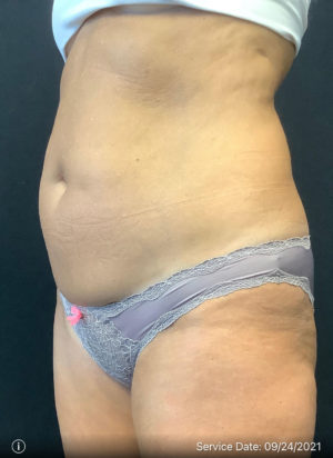 Liposuction