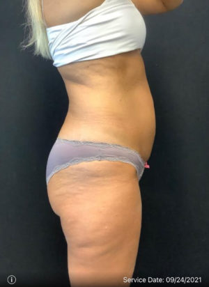 Liposuction