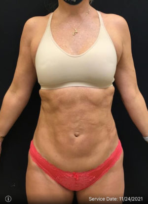 Liposuction