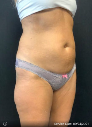 Liposuction