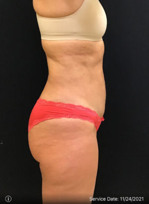 Liposuction