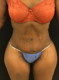 Tummy Tuck