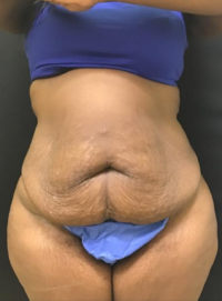 Tummy Tuck