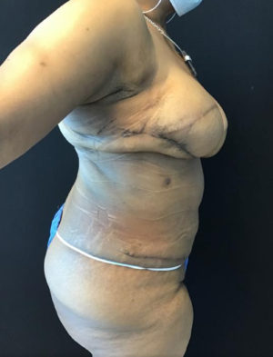 Breast Reconstruction