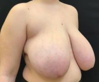 Breast Reduction