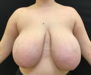 Breast Reduction