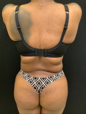 Liposuction