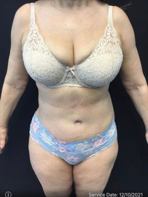 Tummy Tuck